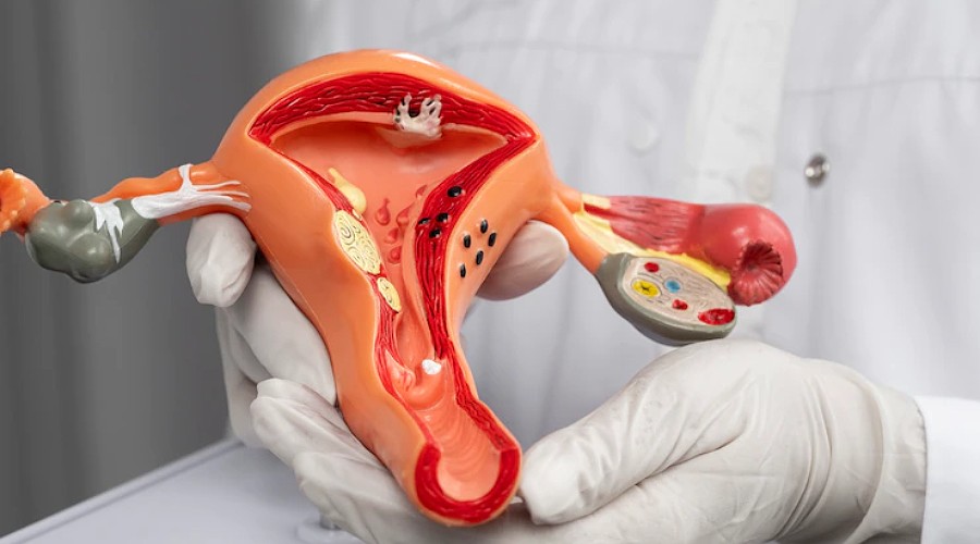 Histerectomia: o que é, quais os tipos e qual tratamento?