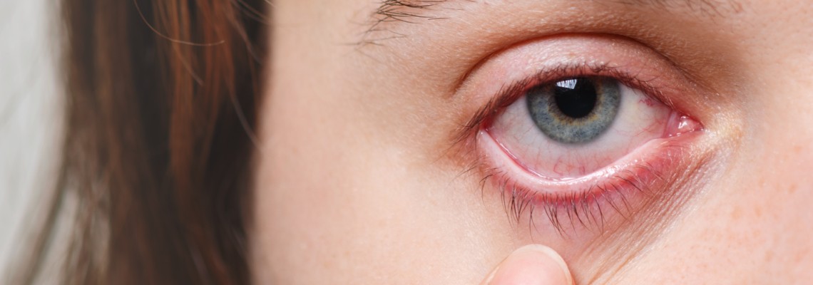 Calázio no olho: o que é, quais os sintomas e tratamentos?