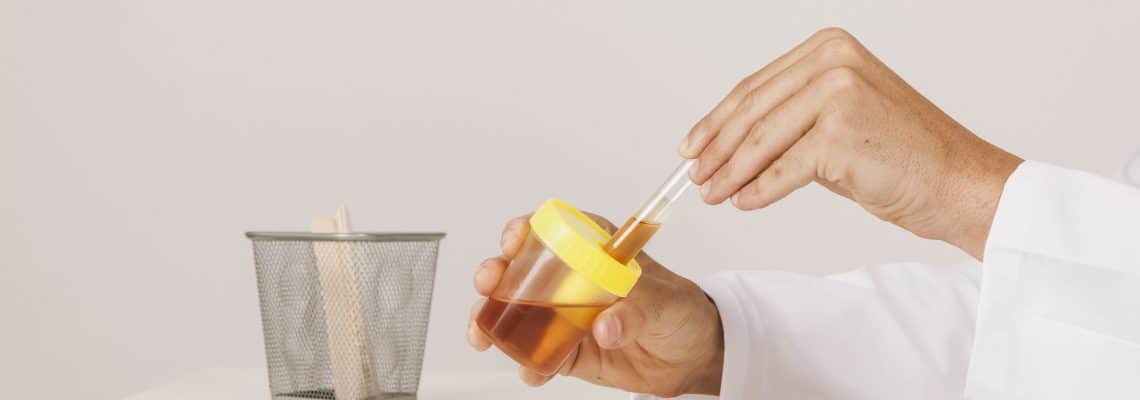 A cor da urina pode revelar doenças?